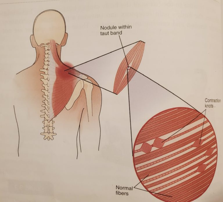 Image of muscles in the neck and back