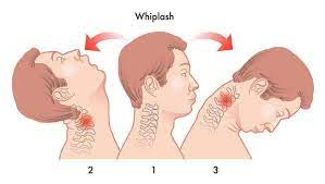 Diagram on how whiplash happens